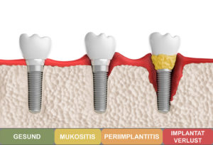 Zahnärztin & Zahntechnikerin Dr. Christine Drechsler - vom gesunden Zahnimplantat über Periimplantitis zum Verlust des Implantates